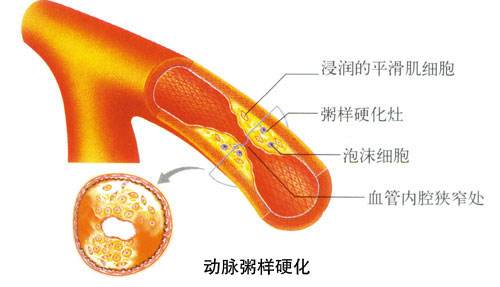 动脉粥样硬化