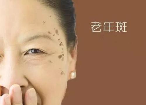 武汉的张女士使用文山三七后 脸上的老年斑变淡了