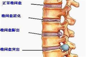 腰椎间盘